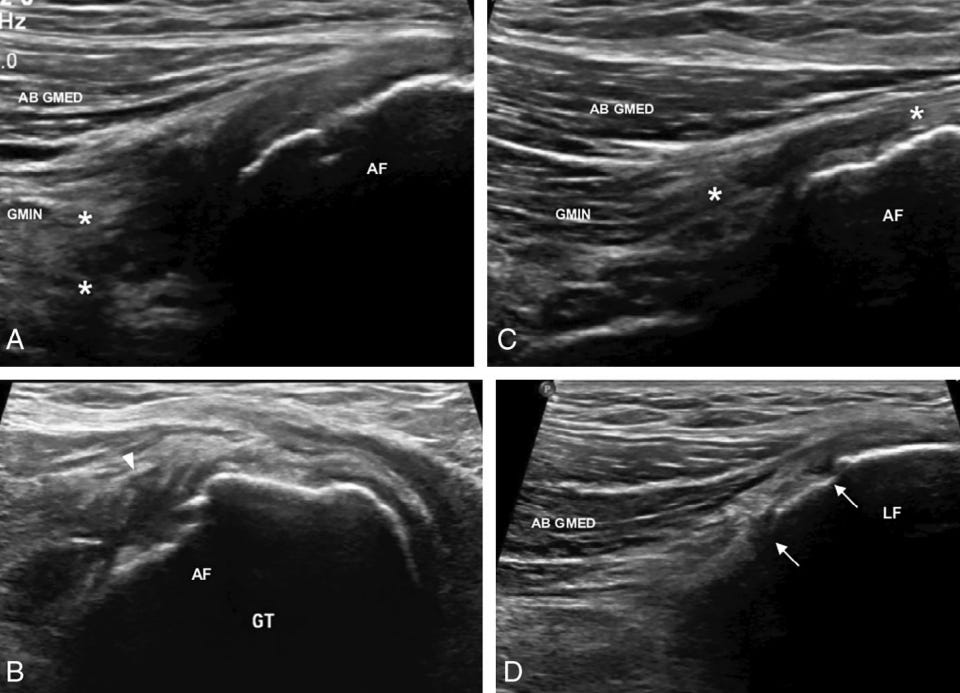 Gluteo menor 7 ecografia tempo formacion.jpg